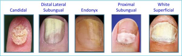 fungal-nail-infection-eliminaser