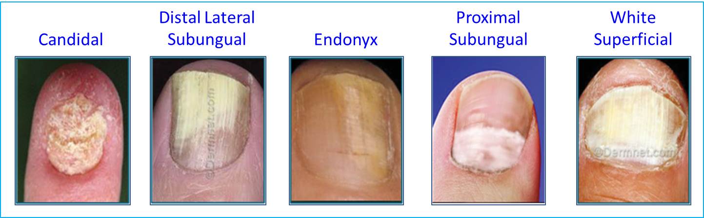 Fungal Nail Infection Eliminaser 